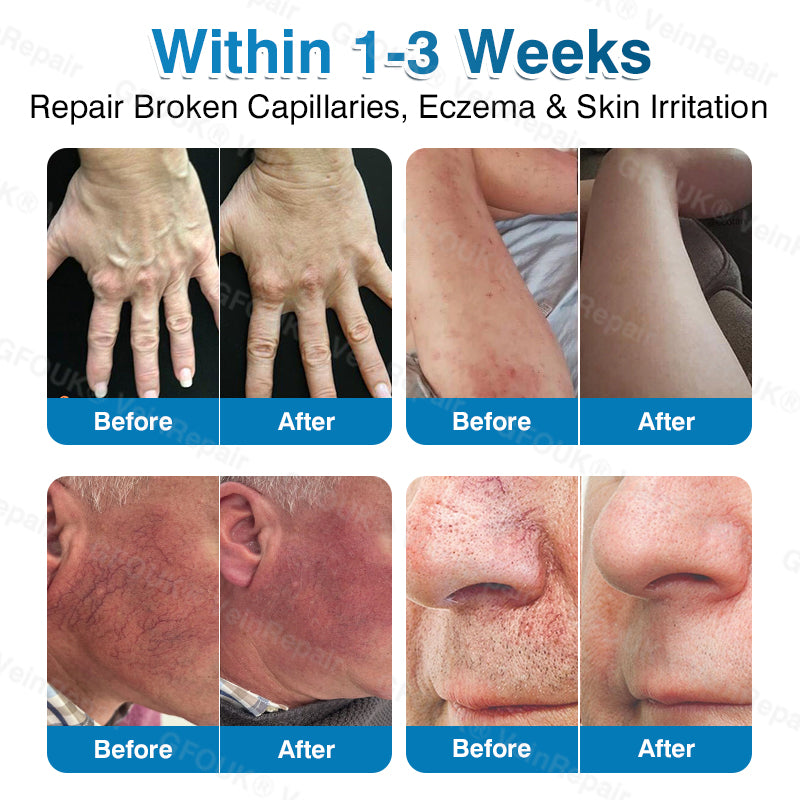 🇨🇦👨‍⚕️✅GFOUK® VeinRepair Microneedle Patch Roll⚡Instant Relief, Long-Term Results