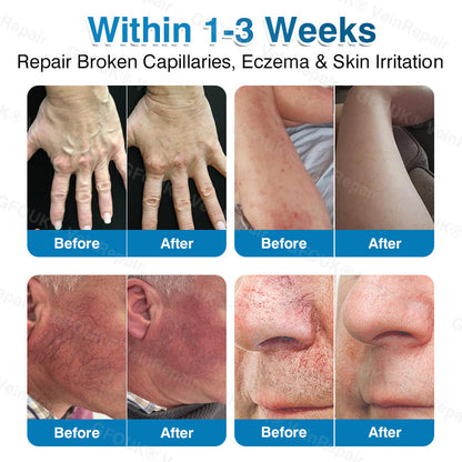 🇨🇦👨‍⚕️✅GFOUK® VeinRepair Microneedle Patch Roll⚡Instant Relief, Long-Term Results
