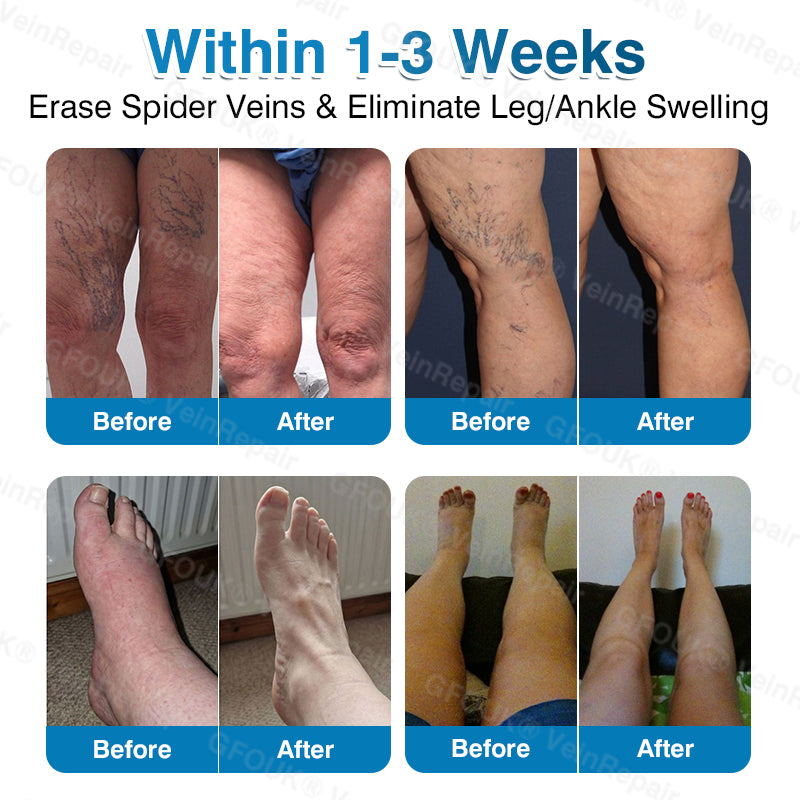 🇨🇦👨‍⚕️✅GFOUK® VeinRepair Microneedle Patch Roll⚡Instant Relief, Long-Term Results