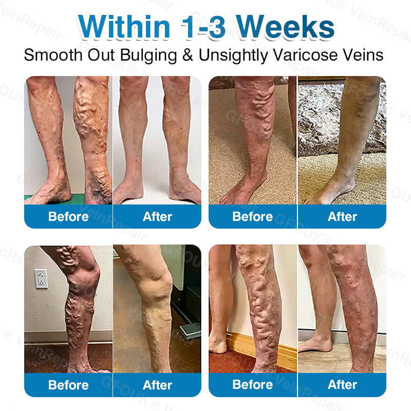 🇨🇦👨‍⚕️✅GFOUK® VeinRepair Microneedle Patch Roll⚡Instant Relief, Long-Term Results